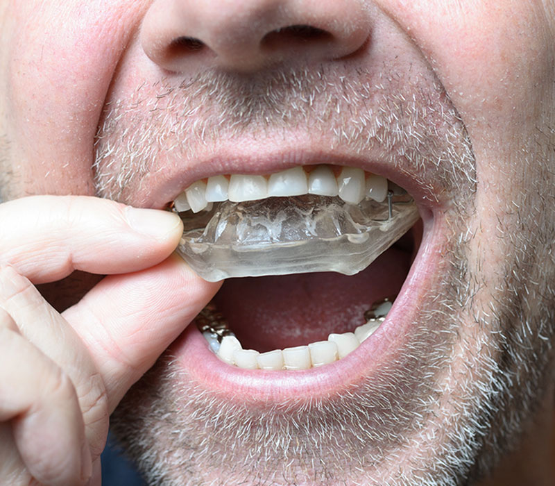 mouth guard in South Miami