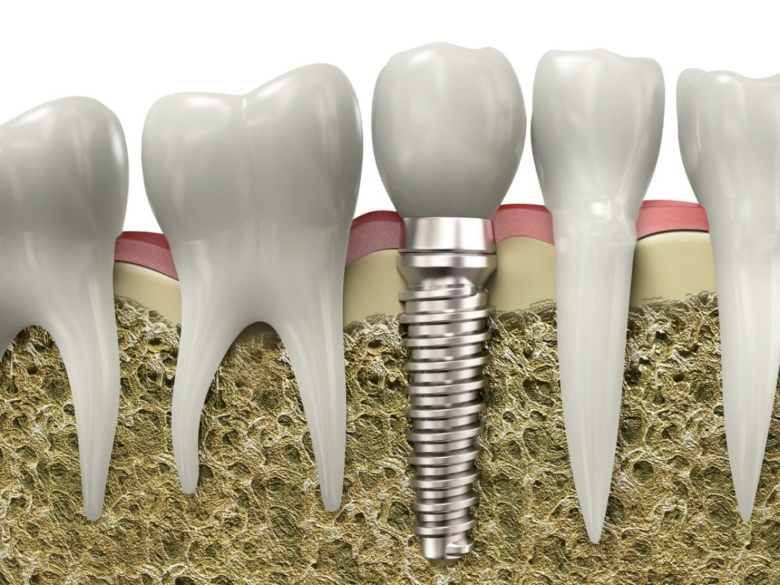Can You Get Dental Implants in One Day?