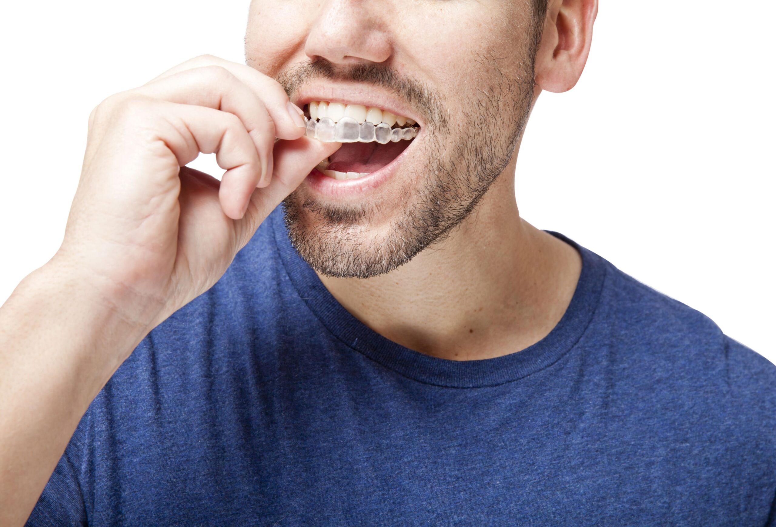 5 facts you should know about invisalign