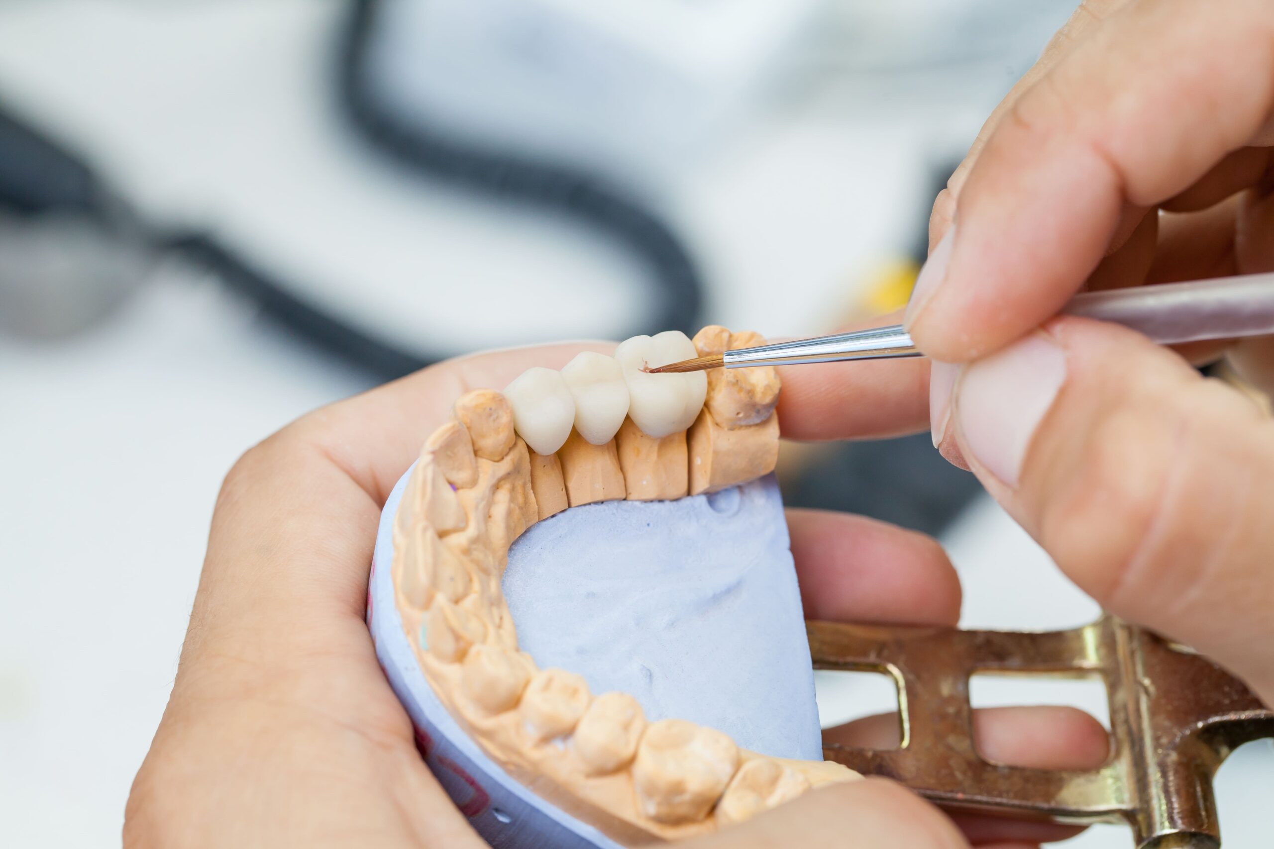 answers to the top 4 faqs about dental bridges