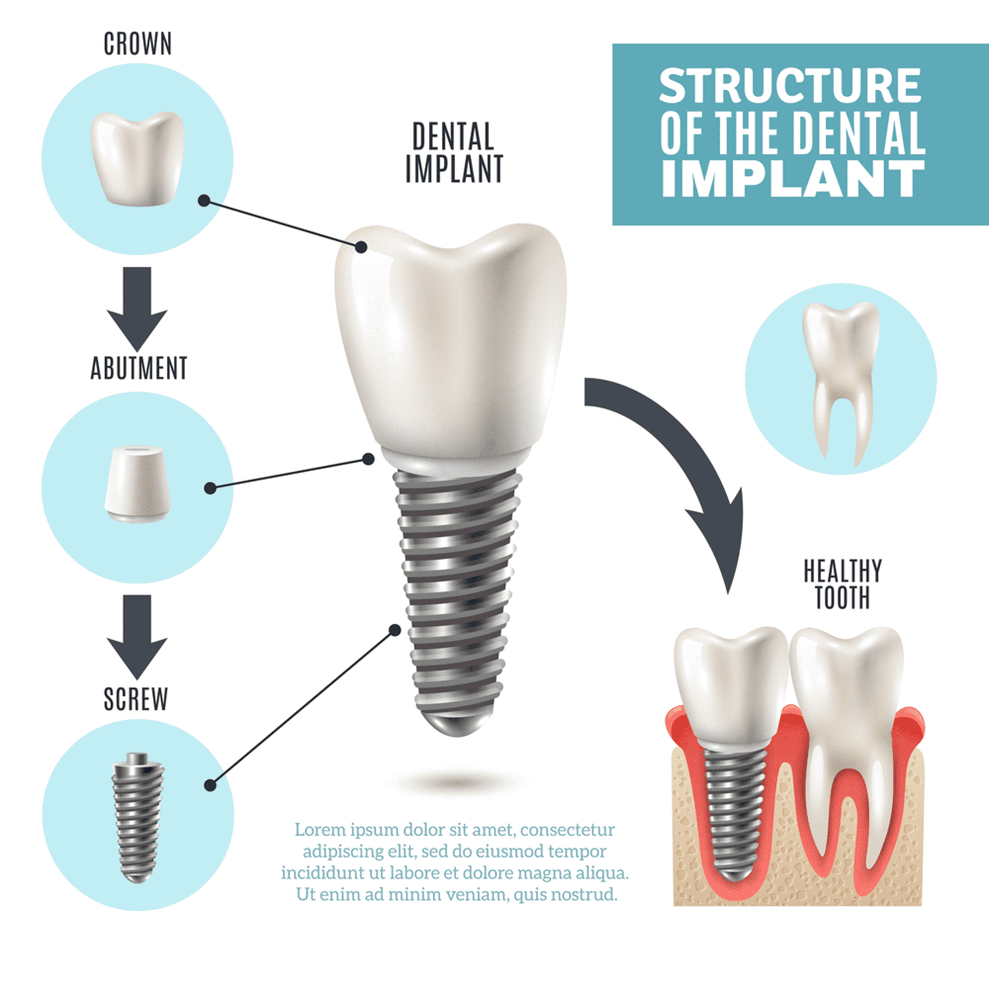 care follow up and maintenance after implants