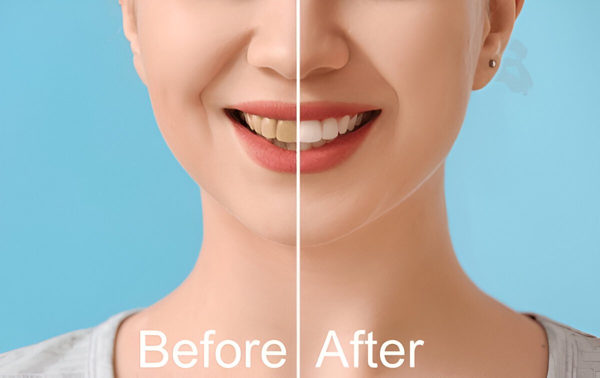 Custom Smile Makeover