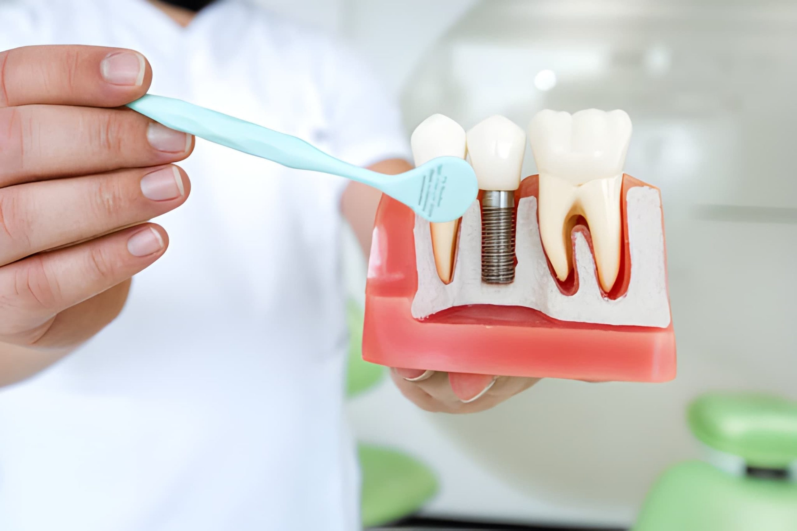 Dental Crowns in South Miami