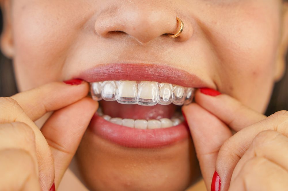 Invisalign